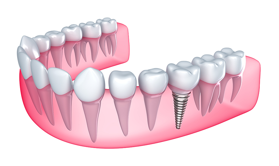 dental-implants-dentist