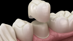 Ceramic Crowns