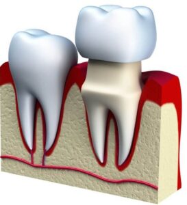 Crown-Lengthening