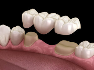 Fixed Dental Bridges