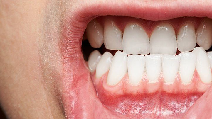 Periodontal (GUM) Disease