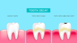 Tooth Decay