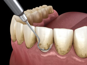 Periodontal Therapy